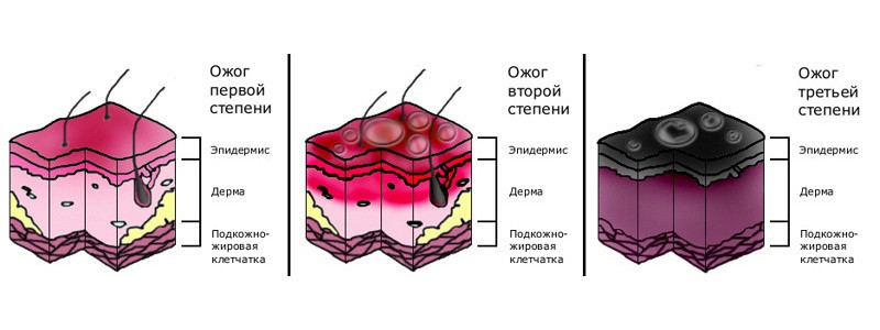 что делать если сгорел на солнце